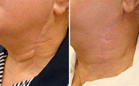 Scar Therapy Vida Wellness And Beauty