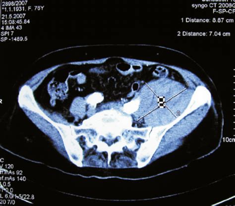 Ct Scan Of Lower Abdomenpelvis Visible Left Sided Retroperitoneal