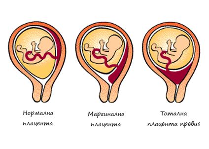Плацента превия - какви са рисковете за бременността ...