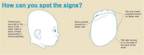 See more of plagiocephaly (flat head syndrome) awareness on facebook. The Difference between Plagiocephaly and Brachycephaly ...