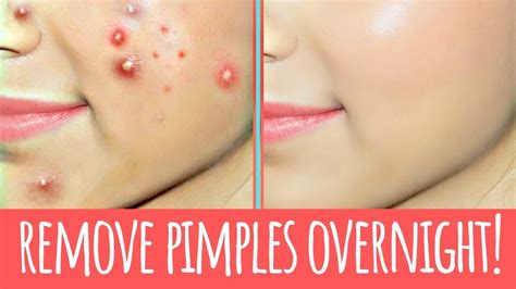 How To Remove Pimples Overnight Acne Treatment How To Remove Pimple