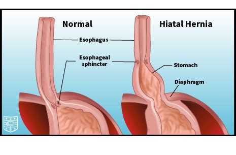 Ask The Doctors Hiatal Hernias Department Of Surgery Washington