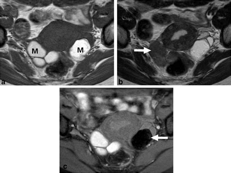 Mri Features Of Ovarian Cystic Lesions Park 2014 Journal Of Magnetic Resonance Imaging