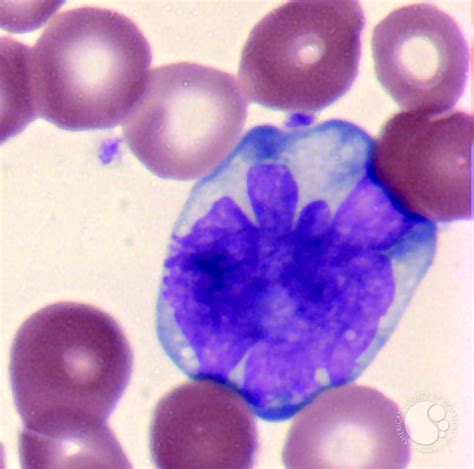 Adult T Cell Leukemialymphoma 3