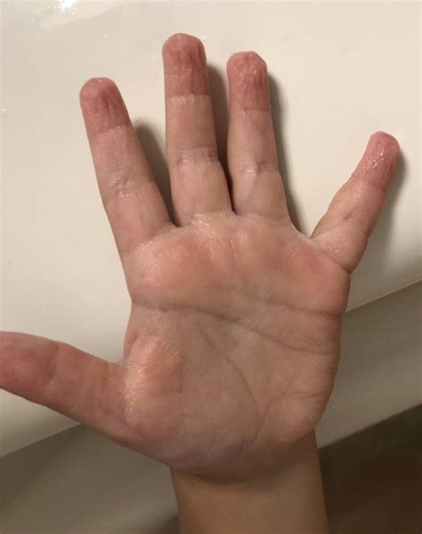 A Thread Written By Tonybreu 1 Why Do My Fingers Get All Wrinkly