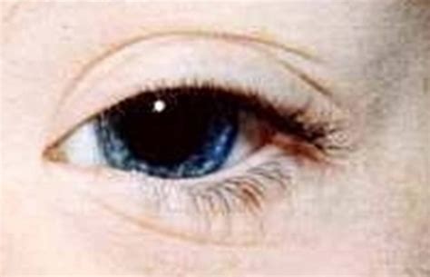 Signs Iris Spots Clinical Eye Openers