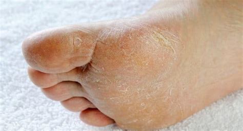 Signs And Symptoms Of 6 Common Feet Problems