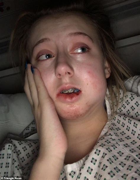 When it comes to correcting and managing an underbite, there are plenty of options to choose from. Bedale teenager Jodie Bowers bullied for severe overbite ...