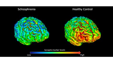 New Study Finds Evidence For Reduced Brain Connections In Schizophrenia