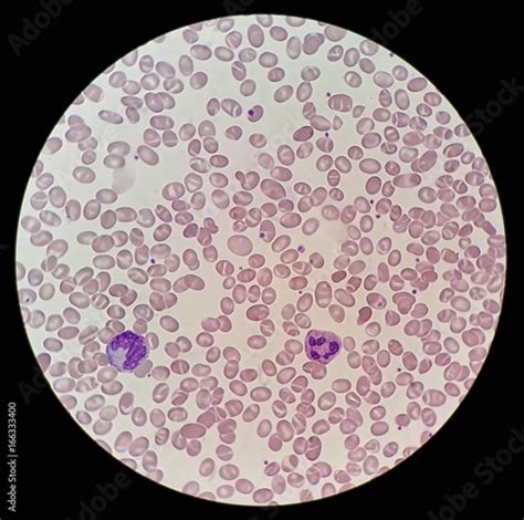 Human Blood Smear With Abnormal Red Blood Cells Morphology Call