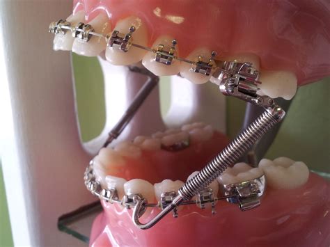Another Option We Have Available To Correct Class Ii Malocclusion Is To Insert These Coil