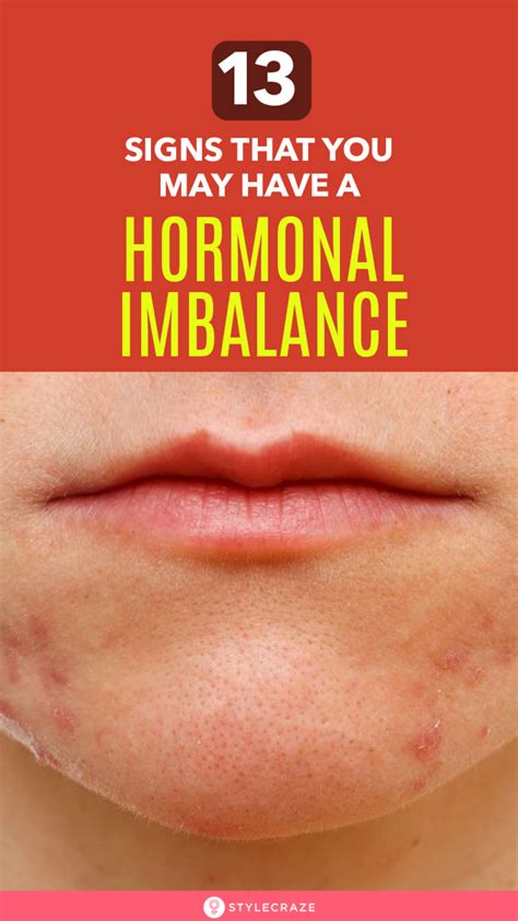 13 Signs That A Person May Have A Hormonal Imbalance With Images Hormone Imbalance Hormones