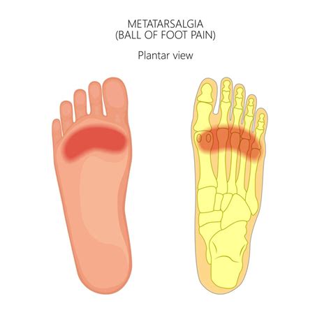 Metatarsalgia Caruso Foot And Ankle