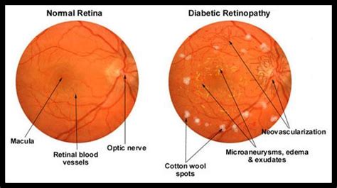 Northampton Diabetic Eye Care Prevent Vision Loss