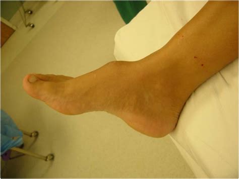 Tumor Of The Foot The Foot And Ankle Online Journal