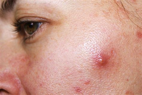 How To Get Rid Of Cystic Acne Best Health Canada