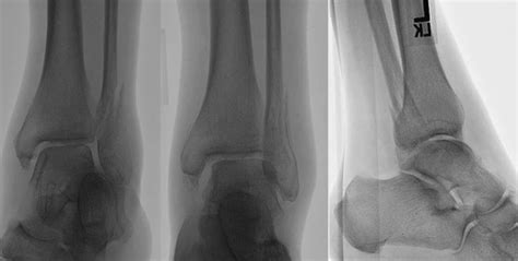 Two View Gravity Stress Imaging Protocol For Nondisplaced Type Ii