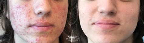 Treatment For Acne Isotretinoin Peels And Lasers