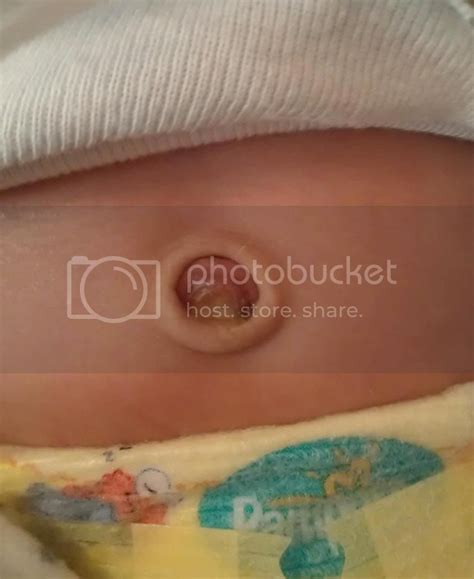 Now, the baby's ready for a regular bath. question ? Umbilical cord (pic) - BabyCenter