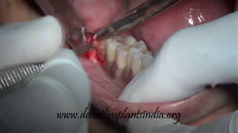 Mesioangular Impacted Wisdom Tooth Removal Open Surgical Method Youtube