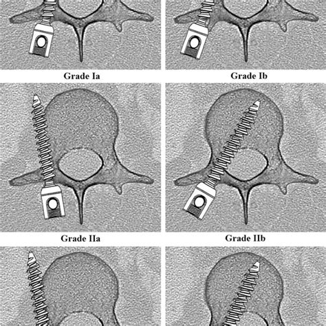 Pedicle Screw Scoring System For Evaluation Of Pedicle Screw Placement Download Scientific