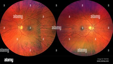 Photograph Of The Fundus Oculi Left And Right Eye Stock Photo Alamy