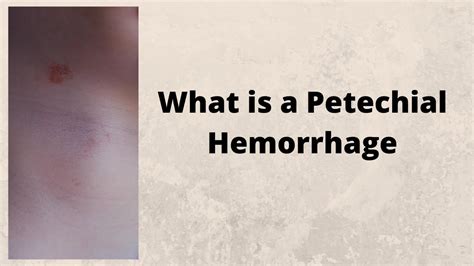 What Is A Petechial Hemorrhage Youtube