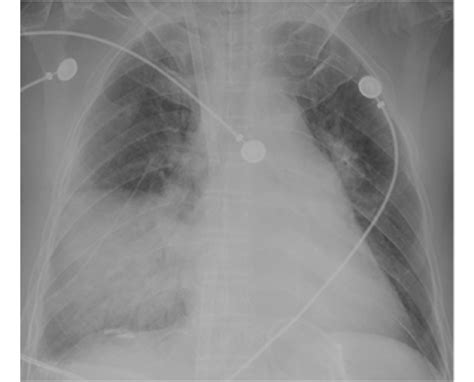 Chest X Ray Showed Consolidation Of Lower And Middle Lob Of Right Lung