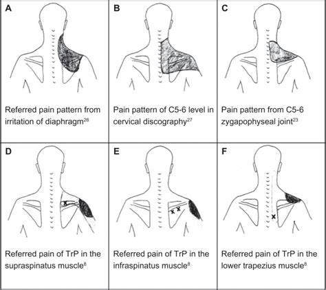 Shoulder Pain Diagnosis Chart Popping Sound