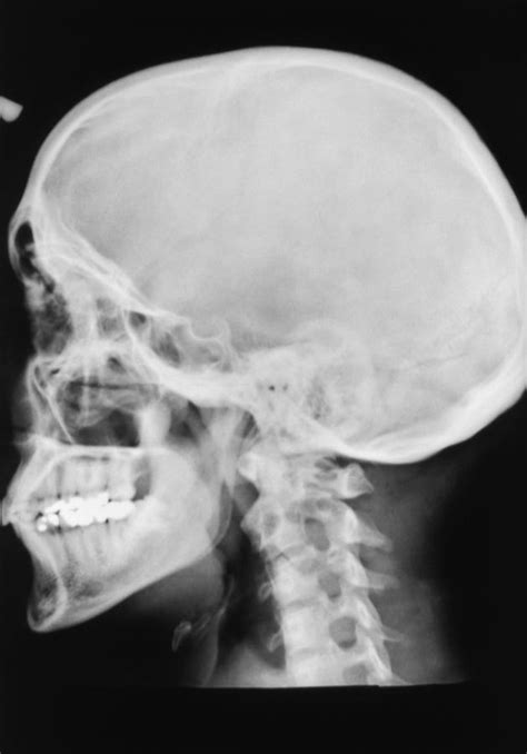 Normal Skull X Ray Photograph By Armed Forces Institute Of Pathology