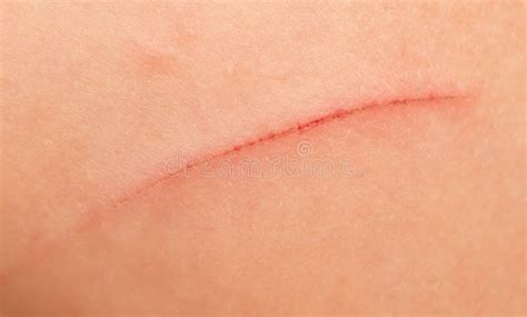 Wound In Human Skin Stock Image Image Of Macro Inflammation 107517377