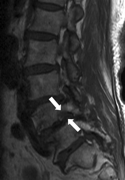 A Practical Mri Grading System For Lumbar Foraminal Stenosis Ajr