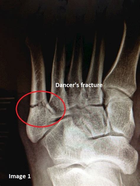 Fifth Metatarsal Fracture Treatment And Tips Metatarsal Fractures