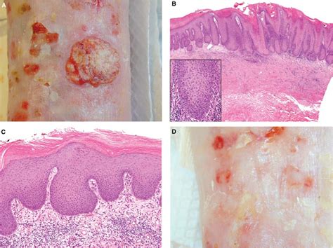 Figure 2 From Mohs Micrographic Surgery For Squamous Cell Carcinoma