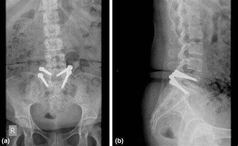 Plain Radiographs Of Lumbosacral Spine Views Showing A Dynamic