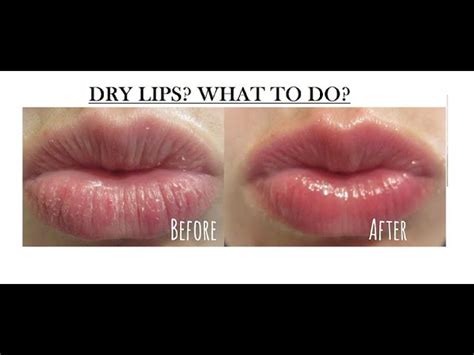 Why Lips Get Dry In Pregnancy Lipstutorial Org