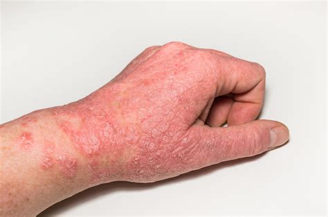 How Tcm Treats Eczema And Topical Steroid Withdrawal