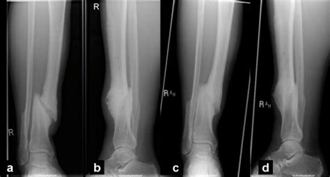 Anteroposterior A And Lateral Radiographs B Of A Distal Tibial