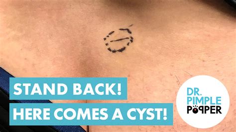 Stand Back Cyst Removal And Cut Cystactular Cysts Dr Pimple Popper