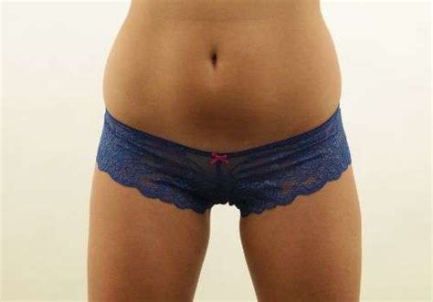 Labiaplasty Manchester Procedures Reflect Clinic
