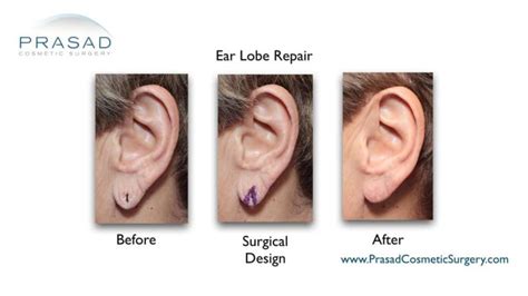 Can Stretched Or Torn Earlobes Be Repaired Dr Prasad Blog