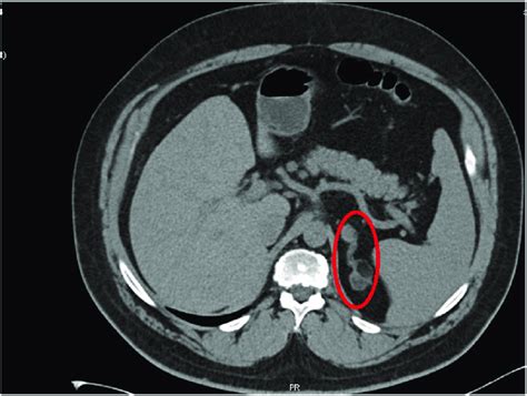 Abdominal Ct Scan Showing An Enlarged And Thickened Left Adrenal Gland