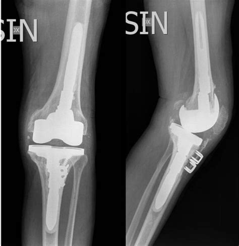 Post Operative Radiographs Following The Tka Revision Without
