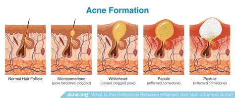 What Is The Difference Between Inflamed And Non Inflamed Acne