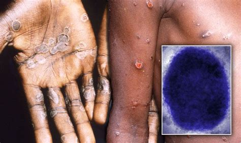 Monkeypox Virus Infection Spread In Uk By Clothes And Sneezing