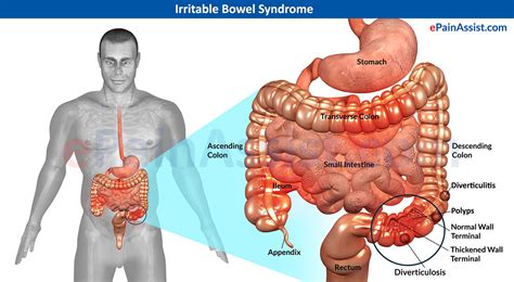 Ibs And Ibd Definition Symptoms And Treatment
