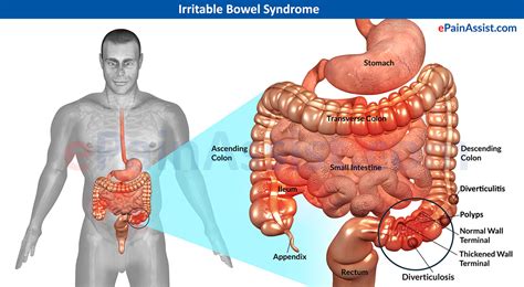 You need to insist on a colonoscopy, it is the only way to rule cancer out and get rid of the cancer worry which if it is ibs, stress makes worse. IBS and IBD: Definition, Symptoms and Treatment