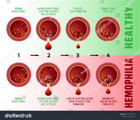 604 Clotting Factors Images Stock Photos And Vectors Shutterstock