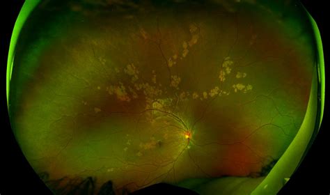 Ophthalmology Dx Tracking The Cause Of White Retinal Spots