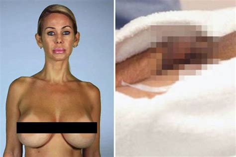 Plastic Surgery Gone Wrong DIY Penis Enlargements And Dodgy Boob Jobs Daily Star